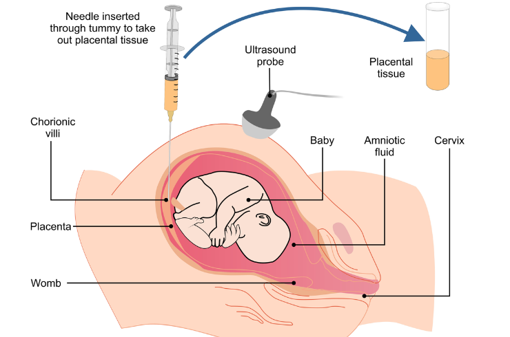 Chorionic villus sampling